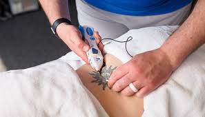 dry needling specialist in Raleigh, NC