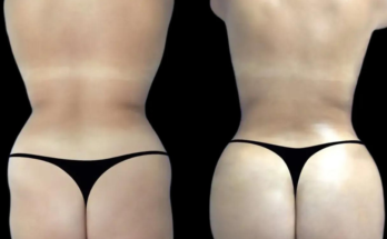 Why Non-Surgical Butt Enhancement Is a Growing Trend in Dubai