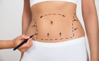 Liposuction Surgery in Dubai