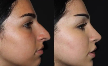 How Long Should I Wear a Splint After Rhinoplasty?