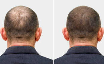 best hair transplant in lahore