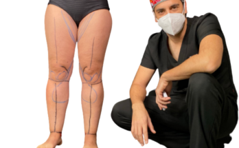 lipedema legs