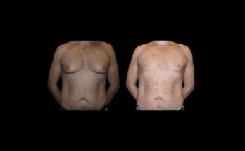 Before and After Male Breast Reduction Result