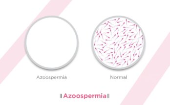 Azoospermia