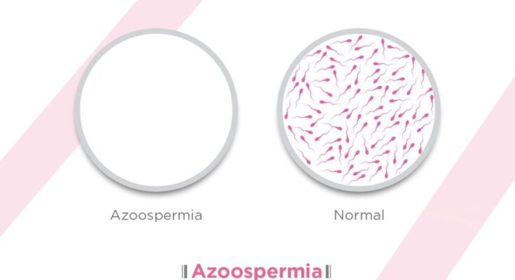 Azoospermia