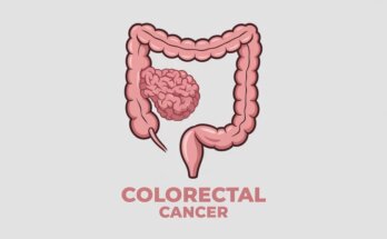 Colorectal Surgeon in Glendale