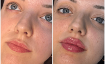 Juvederm Fillers