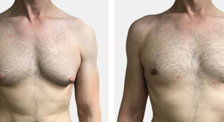 gynecomastia surgery in dubai abu dhabi sharjah