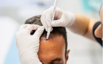 hair transplant near me