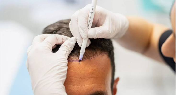 hair transplant near me