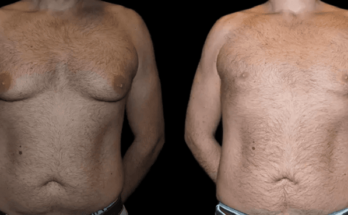 male breast reduction