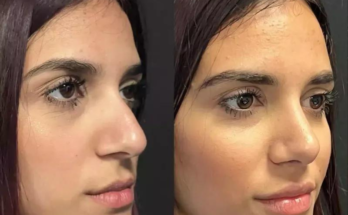 Why Choose Rhinoplasty in Dubai? Benefits, Costs, and Results