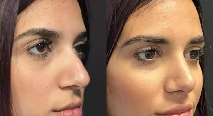 Why Choose Rhinoplasty in Dubai? Benefits, Costs, and Results