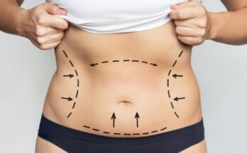 Liposuction in Dubai