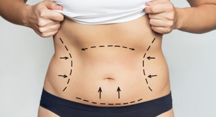 Liposuction in Dubai