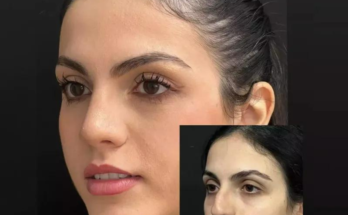 Your Guide to the Best Rhinoplasty Surgeons in Dubai: Achieve the Perfect Nose Transformation