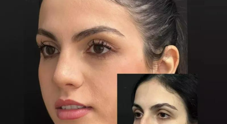 Your Guide to the Best Rhinoplasty Surgeons in Dubai: Achieve the Perfect Nose Transformation