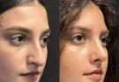 Transform Your Look with Nose Surgery in Dubai