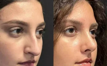 Transform Your Look with Nose Surgery in Dubai