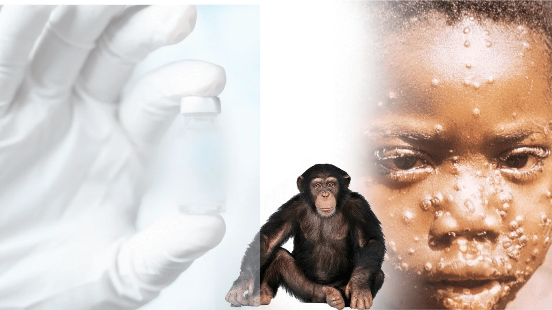 Monkeypox Outbreak
